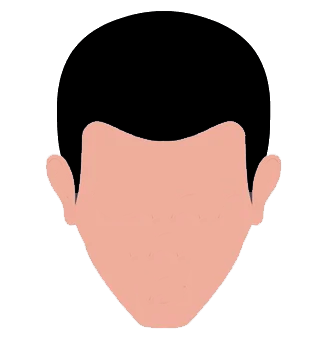 Stages of hair loss - 1