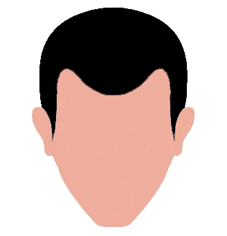 Stages of hair loss - 2