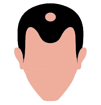 Stages of hair loss - 3