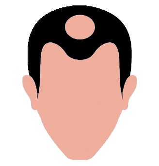 Stages of hair loss - 4