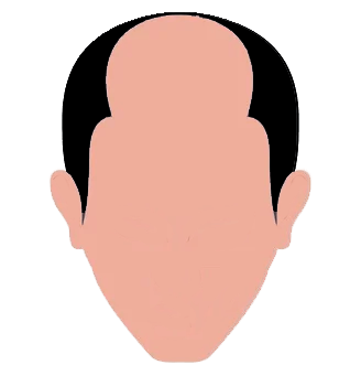 Stages of hair loss - 5