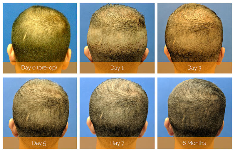 7-day recovery timeline of Nashville hair doctor patient back view