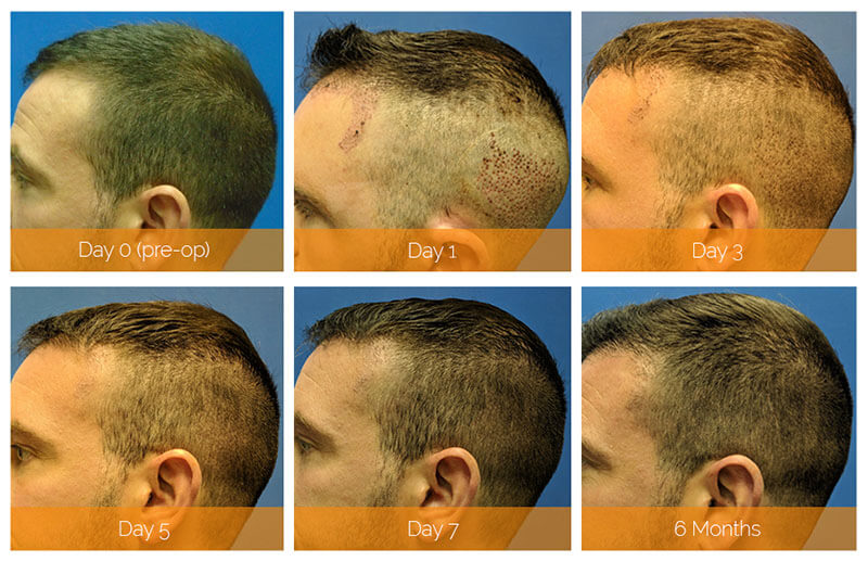 The Secret to Great Hair Transplant Results | Hair Doctor Blog