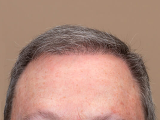 Memphis Hair Doctor patient after picture 6 months