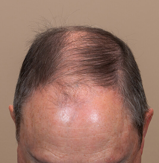 Memphis Hair Doctor patient before picture