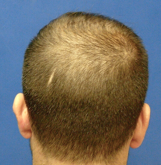 Nashville Hair Doctor patient before picture
