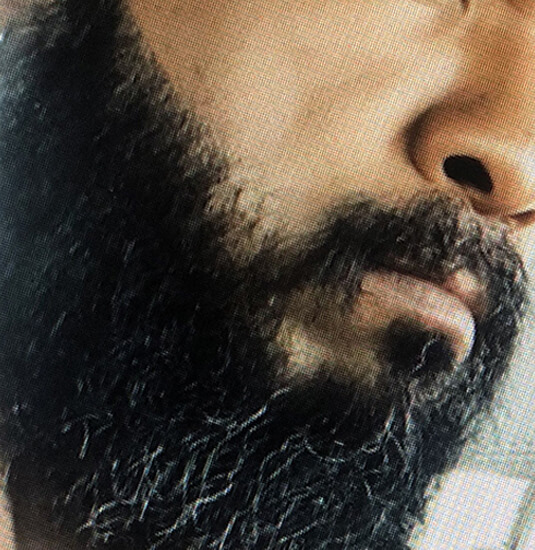 Nashville Hair Doctor beard transplant patient after picture 8 months