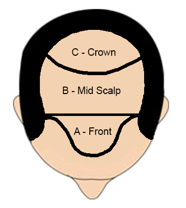 Diagram of hair transplant coverage areas