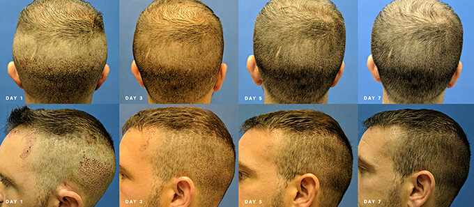 Nashville hair doctor timeline of a patient's recovery day 1-7