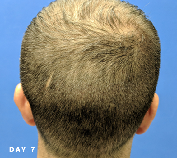 Hair growth after NeoGraft donor area day 7
