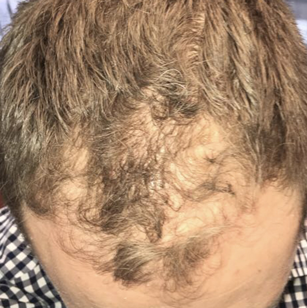 Hair growth after NeoGraft month 0