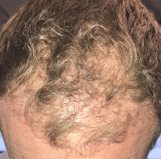 Hair growth after NeoGraft month 2