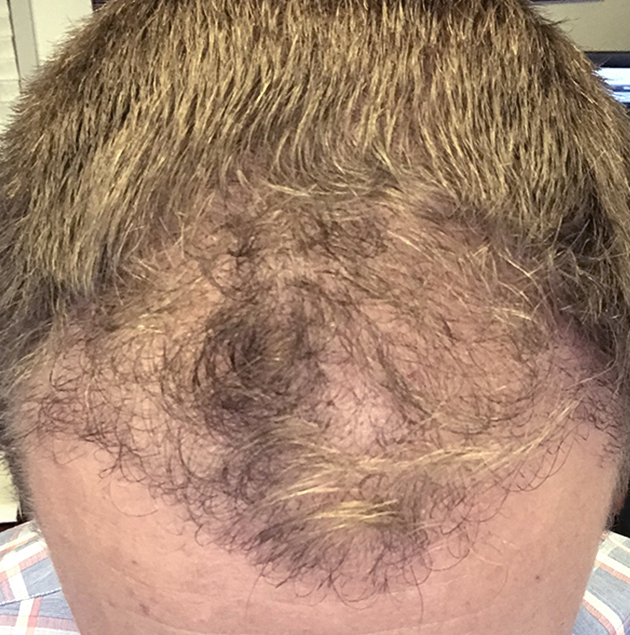Hair growth after NeoGraft month 3