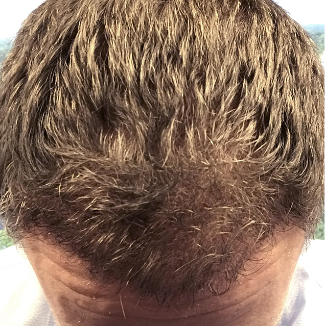 Hair growth after NeoGraft month 5