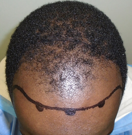 Memphis Hair Doctor patient before picture