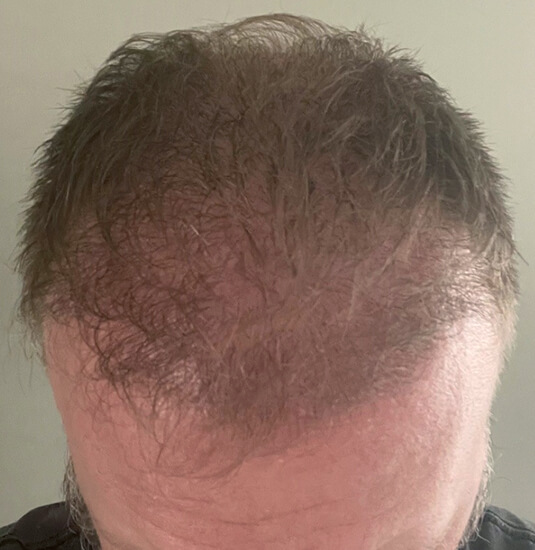 Louisville Hair Doctor patient after picture