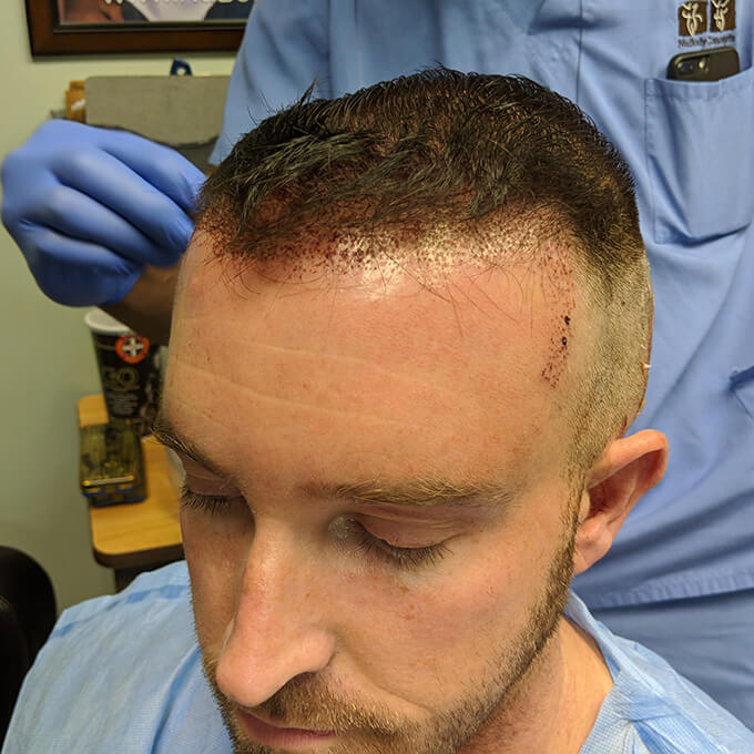 Nashville Hair Doctor David during his hair transplant procedure
