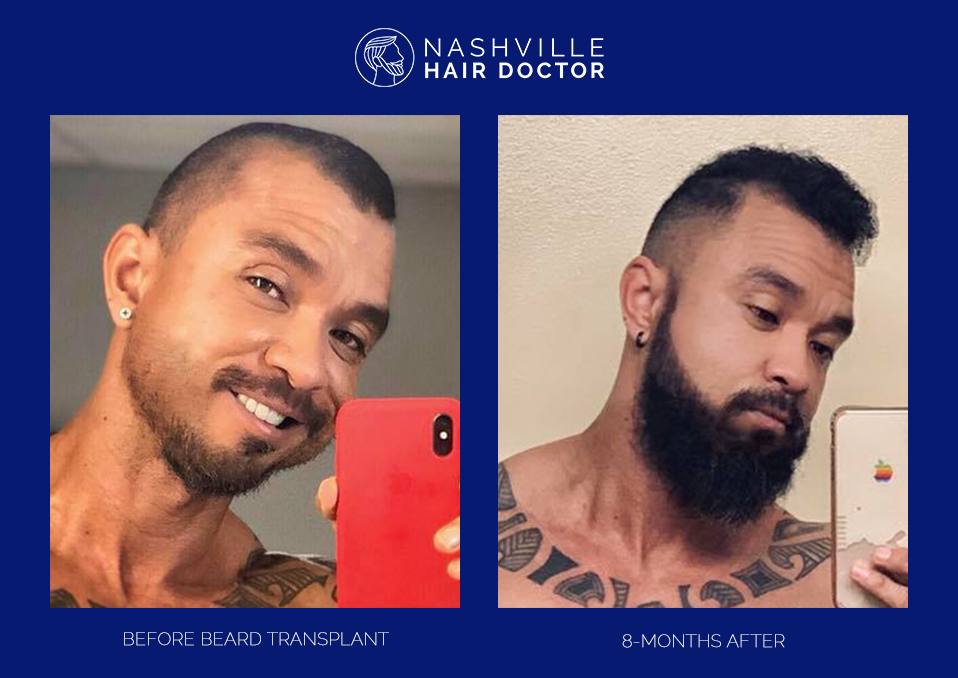 Nashville Hair Doctor patient before and after beard transplant
