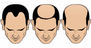 pictograms of different hair loss types
