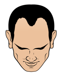 pictogram of hairline with male pattern baldness class 3 hair loss