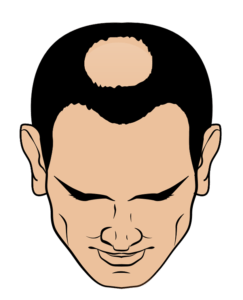 pictogram of hairline with male pattern baldness class 4 hair loss