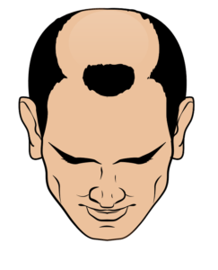 pictogram of hairline with male pattern baldness class 6 hair loss