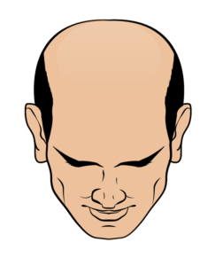 pictogram of hairline with male pattern baldness class 7 hair loss
