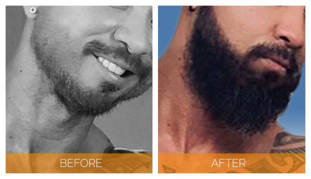 Before and After picture of beard transplant patient | Nashville Hair Doctor