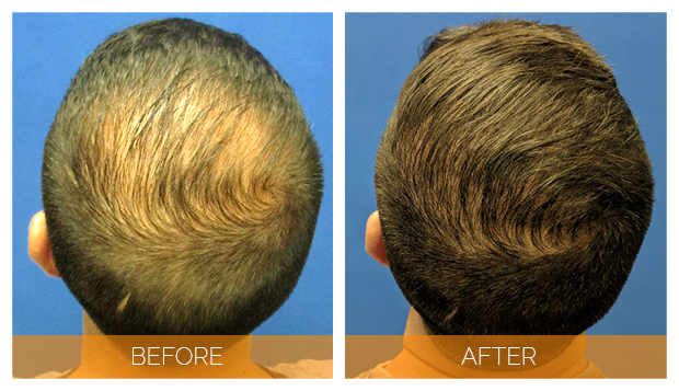 Before and After picture of male NeoGraft hair transplant patient - top view | Nashville Hair Doctor