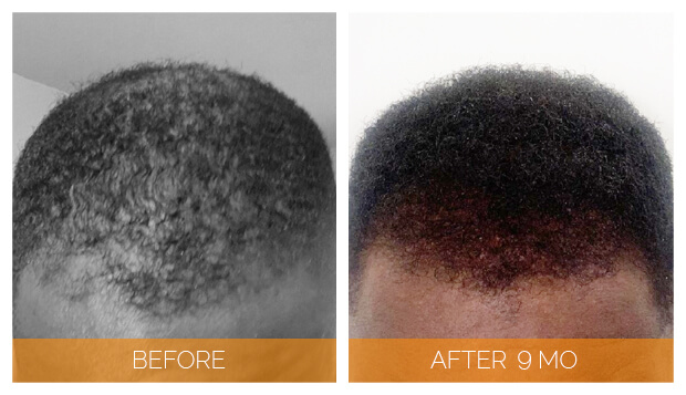 Before and After picture of male NeoGraft hair transplant patient - front view | Nashville Hair Doctor