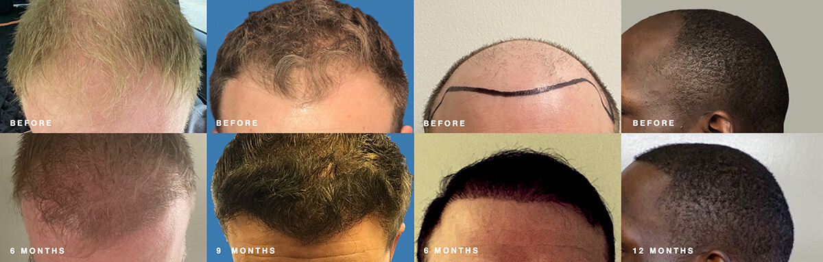 Nashville hair doctor hairline restoration before and after collage