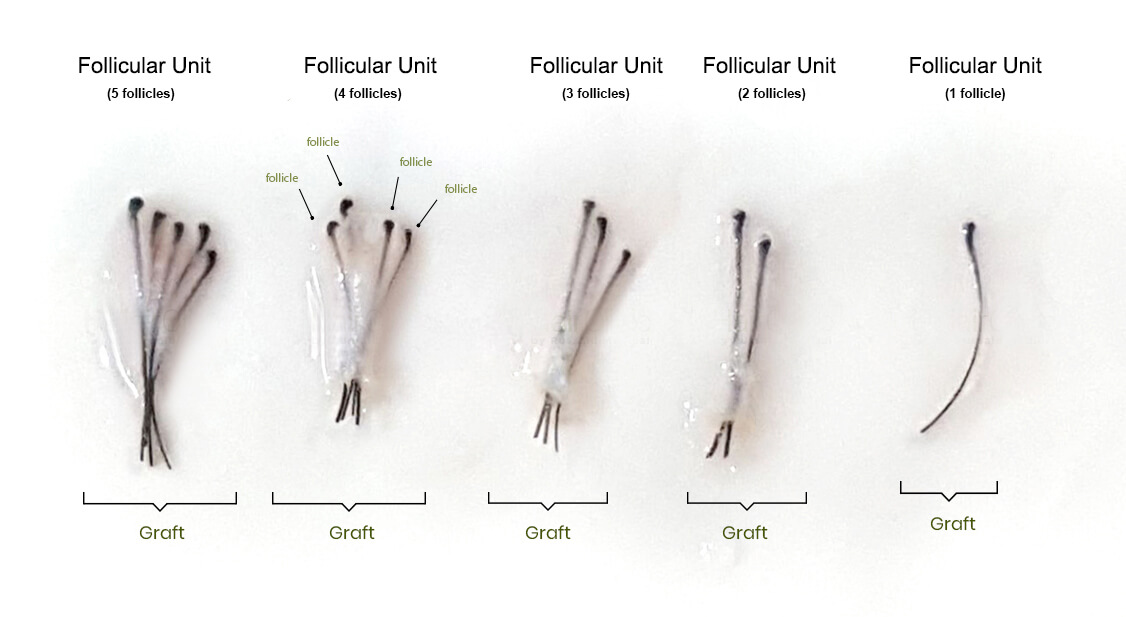 follicular unit hair grafts shown in different groupings of follicles per graft