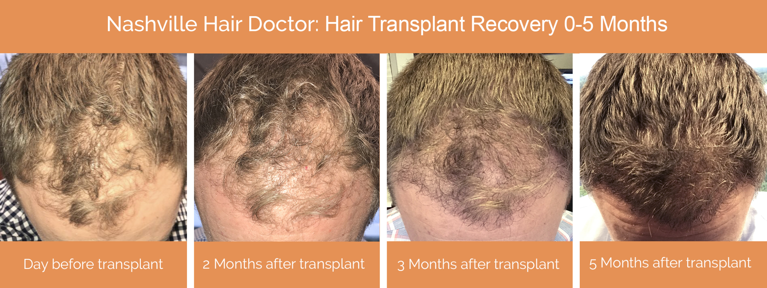 Nashville Hair Doctor patient recovery 0-5 months after hair transplant