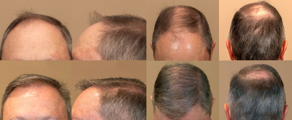 How Fast Does Hair Grow After a Hair Transplant? [Spoiler Alert: Not THAT  Fast] - Nashville Hair Doctor