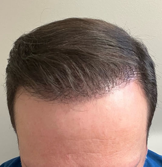 Nashville Hair Doctor patient after 2,500 graft procedure
