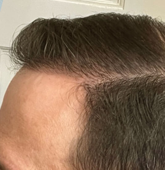 Nashville Hair Doctor patient after 2,500 graft procedure - left side view