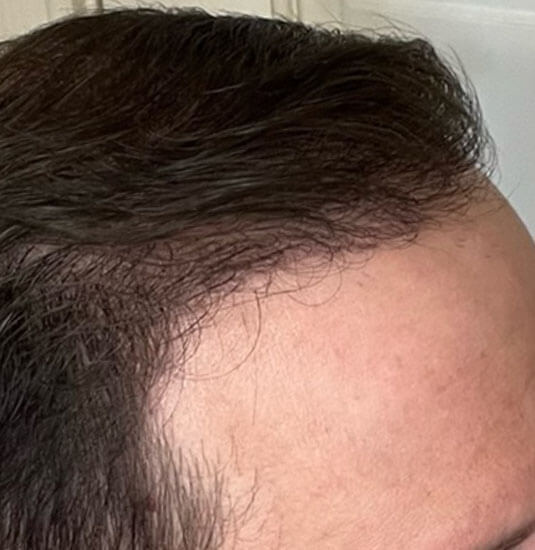 Nashville Hair Doctor patient after 2,500 graft procedure - right side view