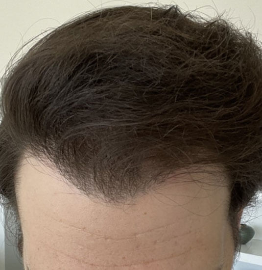 Nashville hair doctor patient after hair transplant front view 12 months post-op