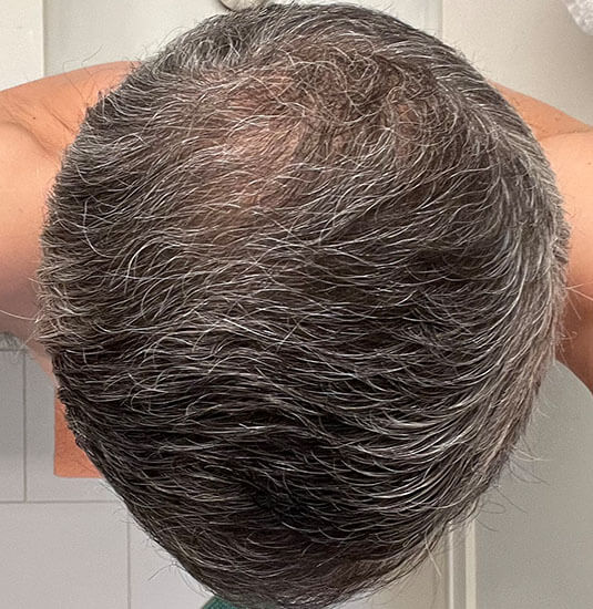 Nashville hair doctor patient after hair transplant top view 6 months post-op