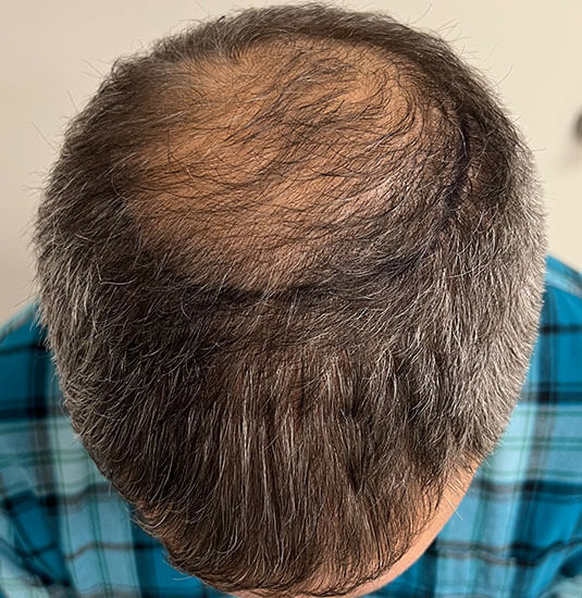 Nashville hair doctor patient before hair transplant top view