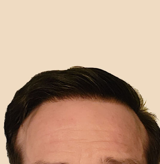 Nashville hair doctor patient after hair transplant front view 14 months post-op