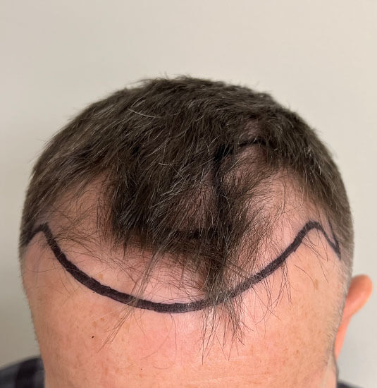 Nashville hair doctor patient before hair transplant tilt view