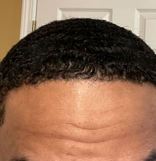 Memphis hair doctor patient after hair transplant front view