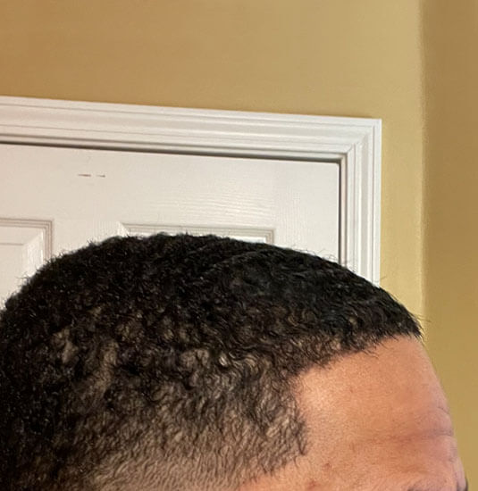 Memphis hair doctor patient after hair transplant side view