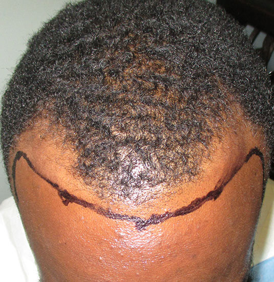 Nashville hair doctor patient before hair transplant front view