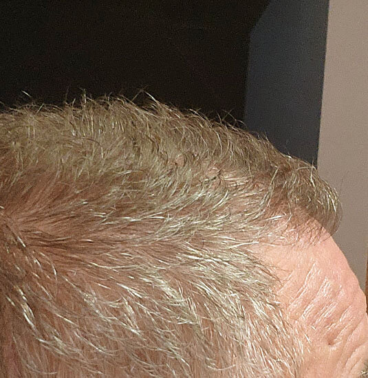 Nashville hair doctor patient after hair transplant side view
