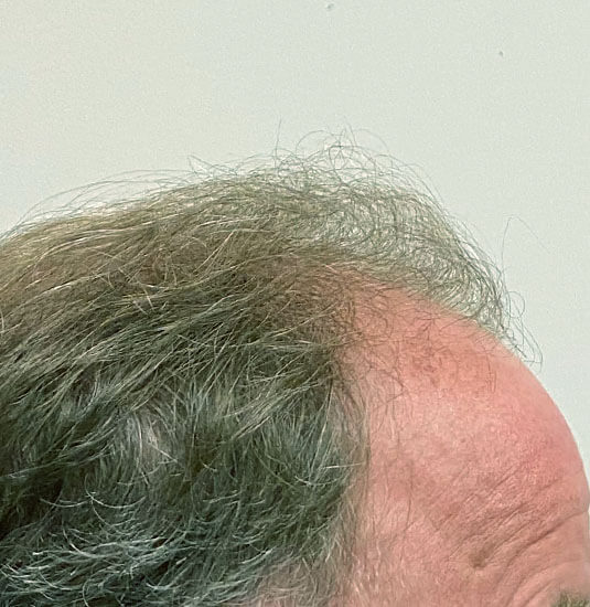 Nashville hair doctor patient before hair transplant side view