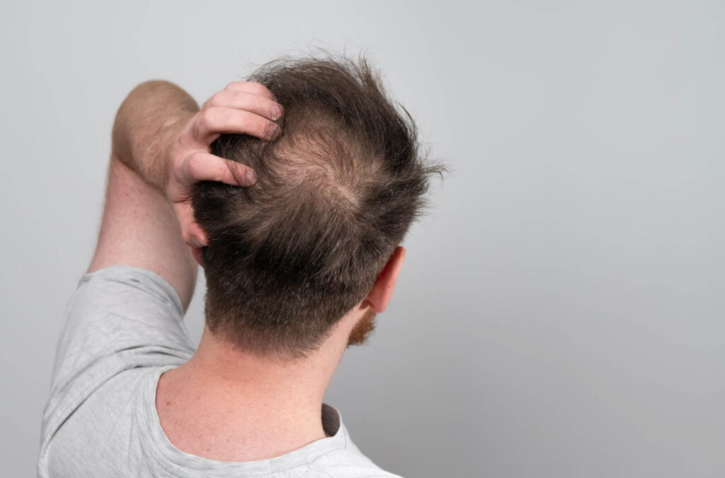 A balding man in Tennessee.