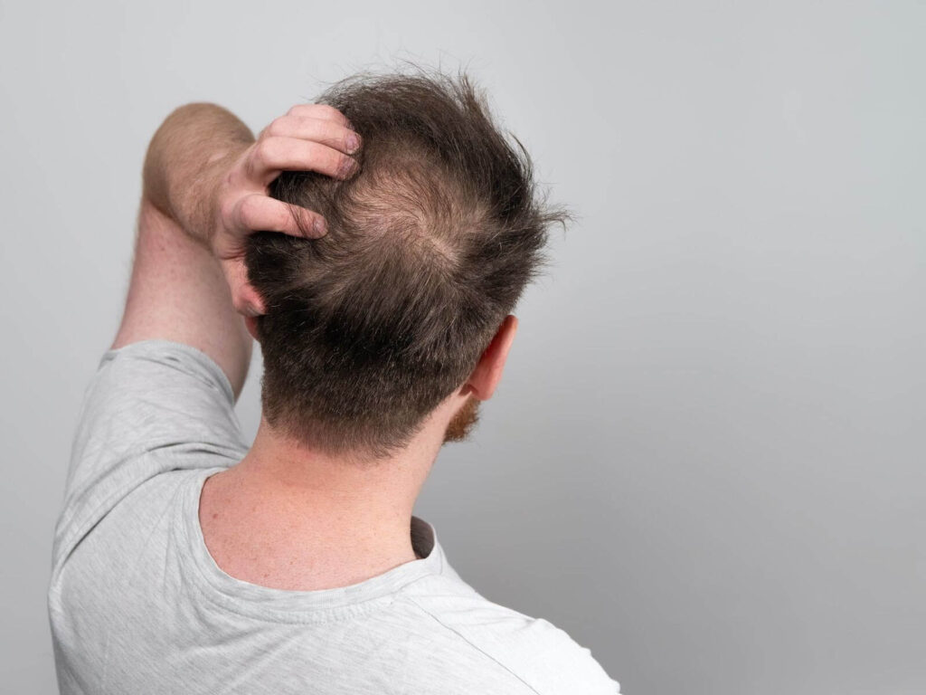 Man in Tennessee examining the hair loss in the crown of their head.