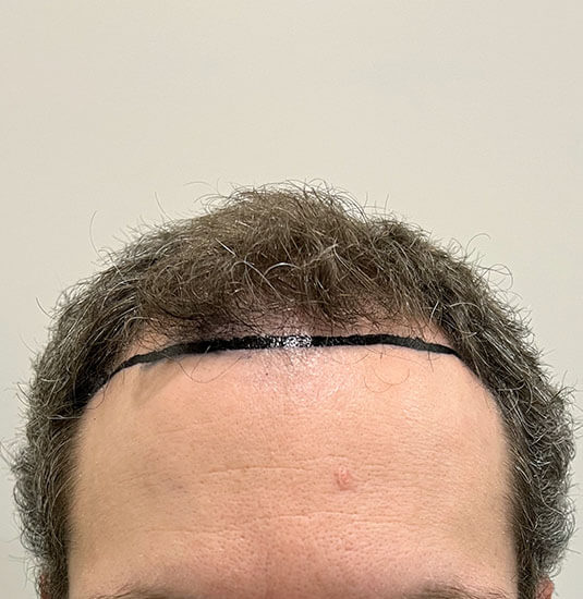Memphis hair doctor patient before hair transplant front view